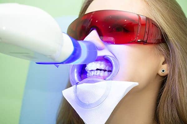 Laser teeth whitening treatments Maidenhead