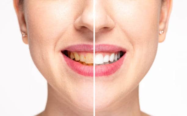 Teeth Whitening Milton Keynes Maidenhead