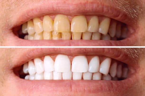 Laser White For Ever Bright – Get a Brighter, Whiter Smile with LA Teeth Whitening Maidenhead