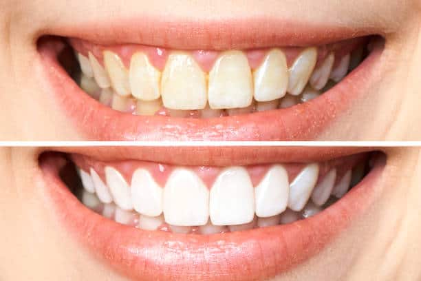 Achieve a Dazzling Smile for Your Special Day: A Guide to Wedding Teeth Whitening Maidenhead