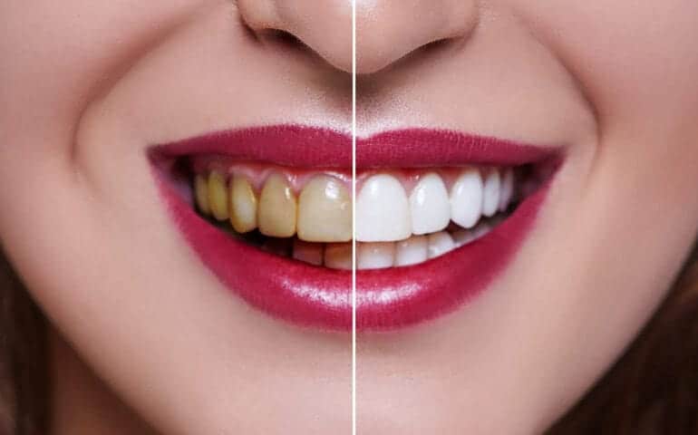 Teeth Whitening Ascot Windsor Maidenhead