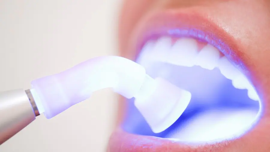 Teeth Whitening Aylesbury Maidenhead