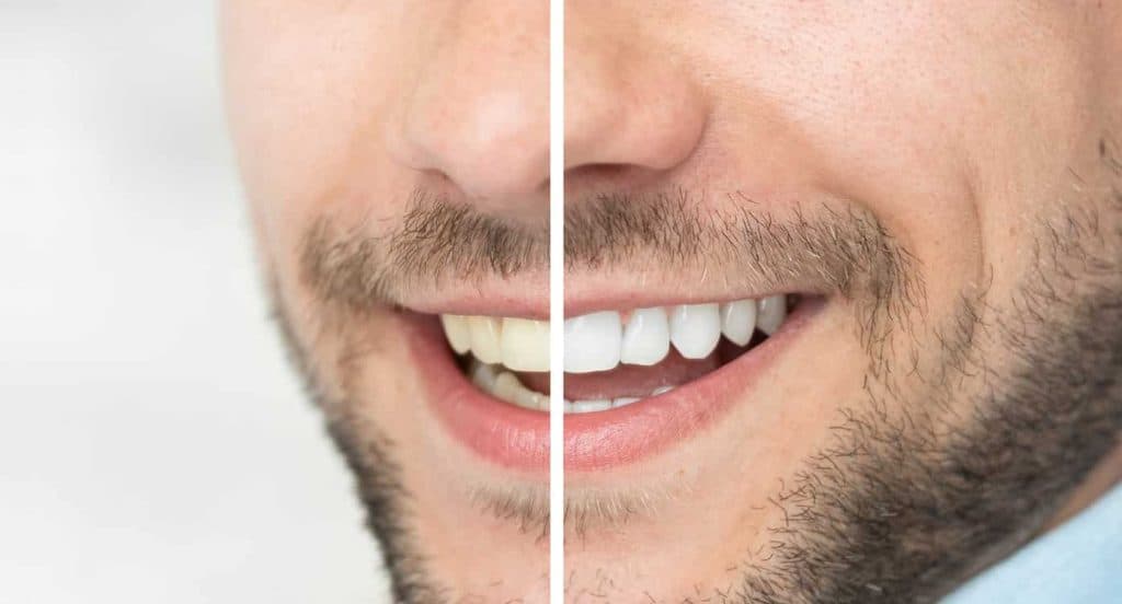 Teeth Whitening Bedfordshire Maidenhead