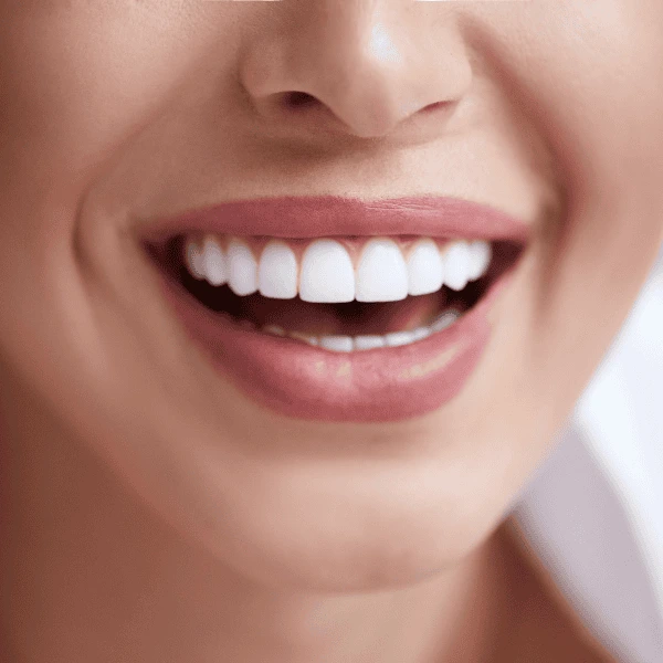 Get A whiter smile fast! Book with LA Teeth Whitening today! Maidenhead