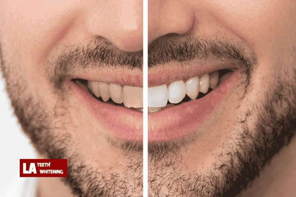 Where to Get Laser Teeth Whitening? Maidenhead